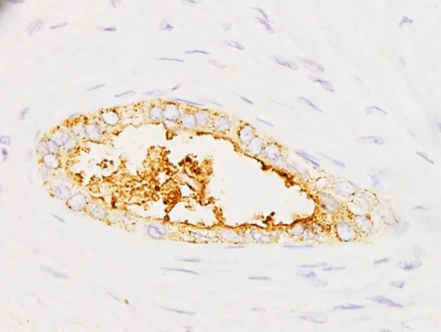 El prototipo de test rápido que detecta el cáncer de páncreas en cuestión de minutos